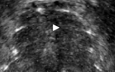 在prot骨放射治疗中用于放射性种子检测的专利待处理方法